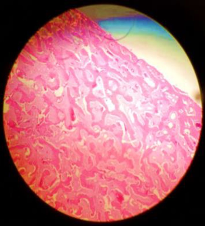 McCune Albright syndrome, craniofacial manifestations, and surgical